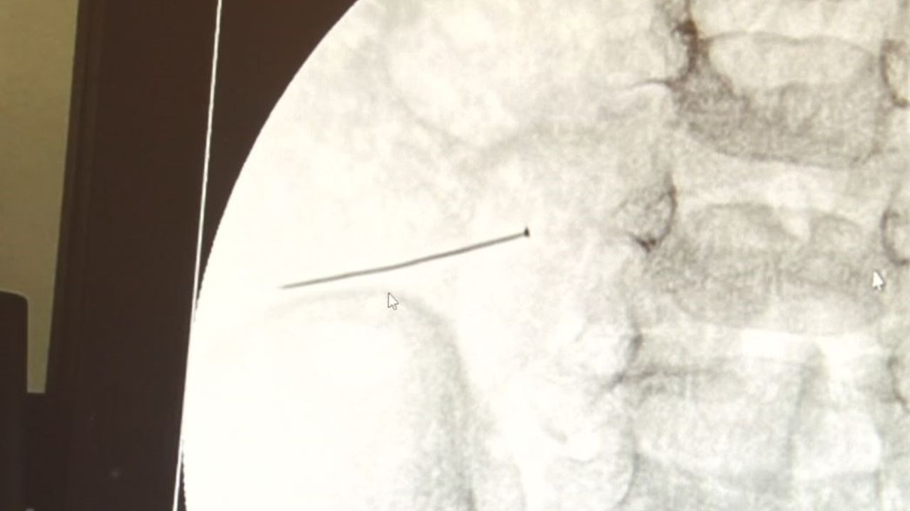 Ağrıyla kıvranan 2 yaşındaki çocuğun  bağırsağından 3 santimlik iğne çıktı