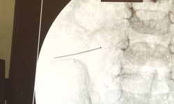Ağrıyla kıvranan 2 yaşındaki çocuğun  bağırsağından 3 santimlik iğne çıktı