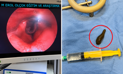 Çorum'da yutma güçlüğü çeken adamın boğazından canlı sülük çıktı