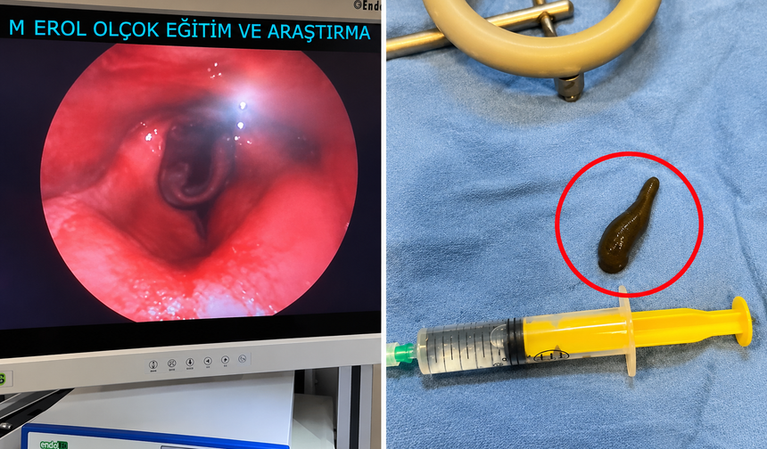 Çorum'da yutma güçlüğü çeken adamın boğazından canlı sülük çıktı